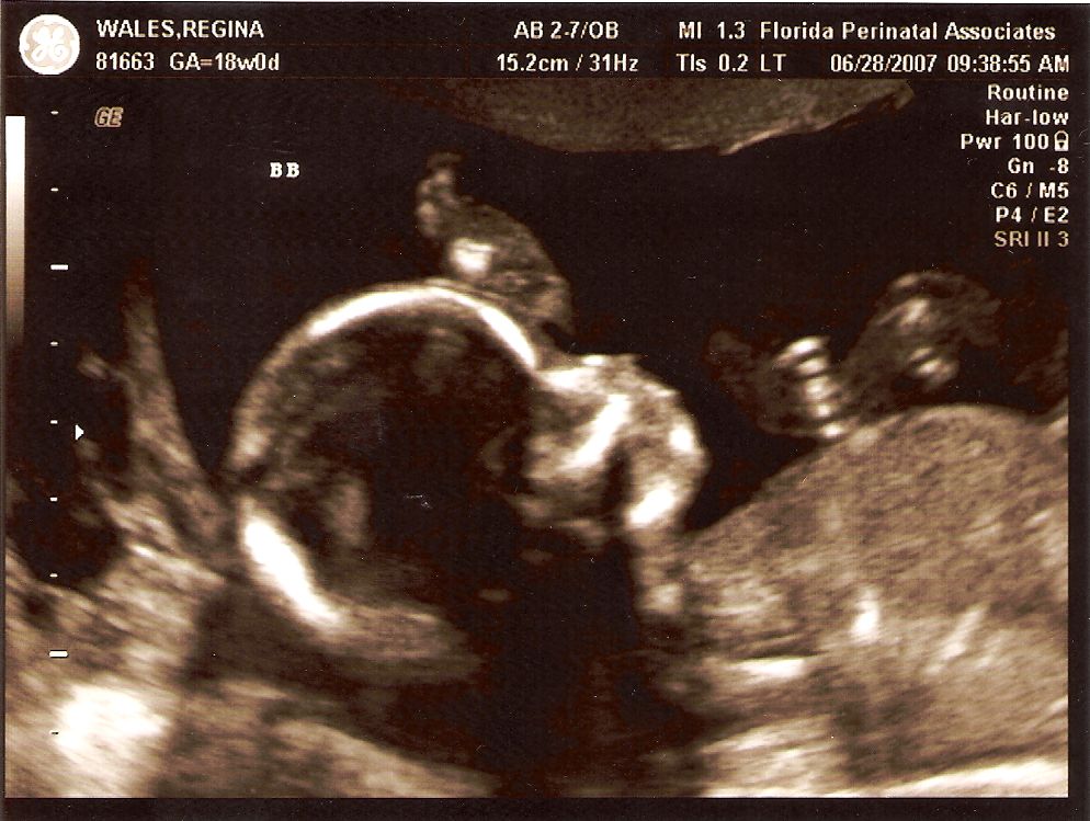 How To Know If It S Twins Before Ultrasound at Leona Ferguson blog