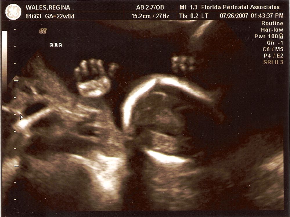 More Ultrasounds of the Twins